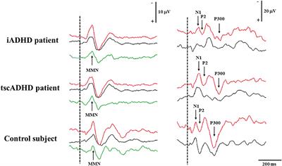 Event-Related Potentials in ADHD Associated With Tuberous Sclerosis Complex: A Possible Biomarker of Symptoms Severity?